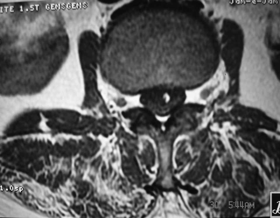 Spine  Fibro Lipoma (3)