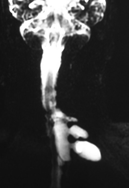 Spine  Foraminal Tumor (8)