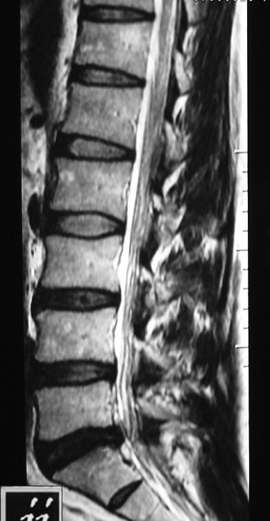 Spine  Lumbar Disc Bulging (2)