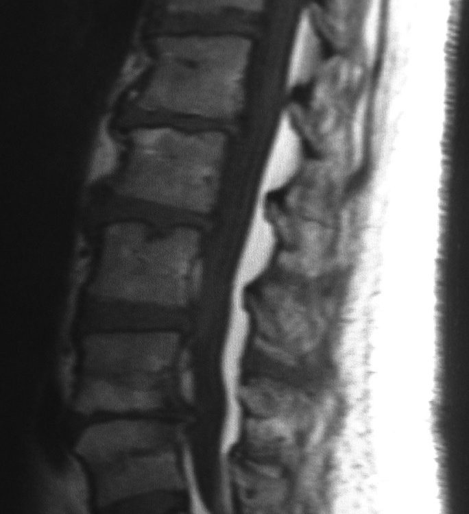 Spine  Multiple Disc Herniation But DDX With Tumor At L3 L4 Extrusion (2)