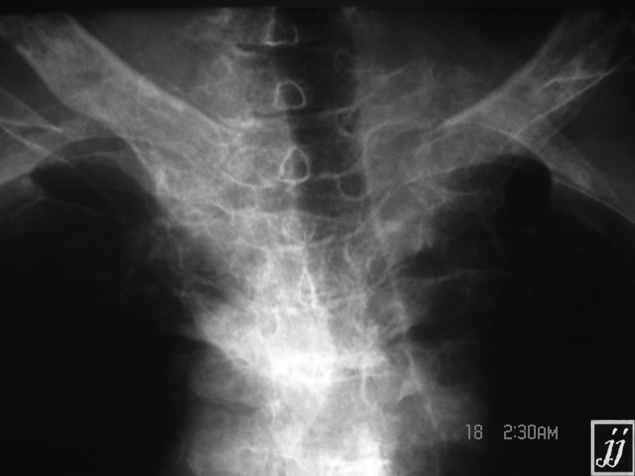 Multiple Myeloma Radiopaedia 