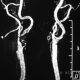 Vascular  Narrow Origin Of Right Internal Carotid Artery (2)