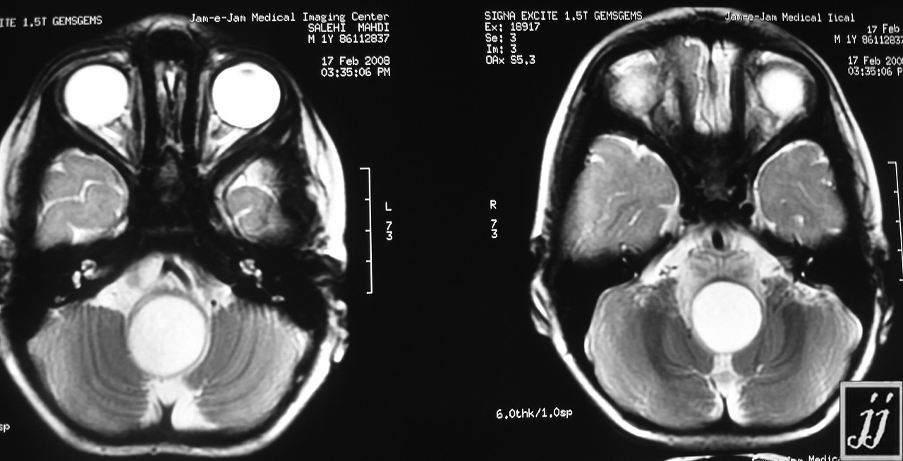 Brain stem tumor – Radiopaedia