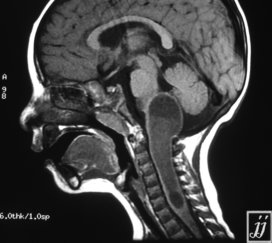 Brain Stem Tumor Radiopaedia