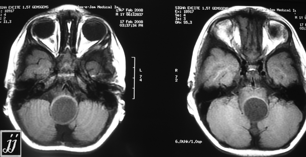 Brain stem tumor – Radiopaedia