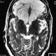 Brain  Large Empty Sellae And Frontal Malatya (3)