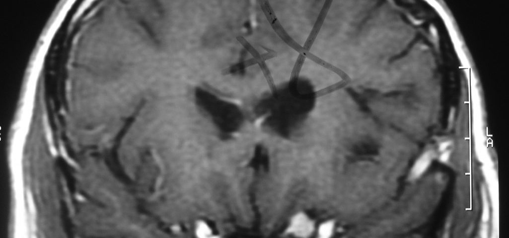 Brain  Left Anterior Clinoidal Meningioma (4)