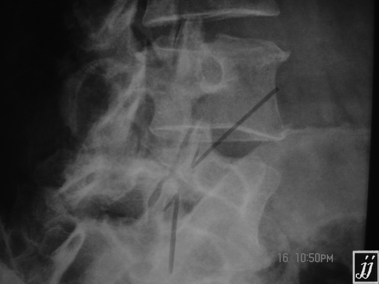Spine Neck Fracture Of Scotty Dog At L5 Spondylolysis 3 