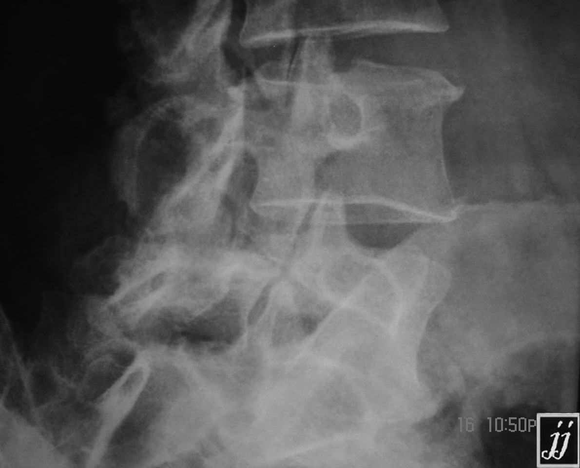 Spine Neck Fracture Of Scotty Dog At L5 Spondylolysis 2 