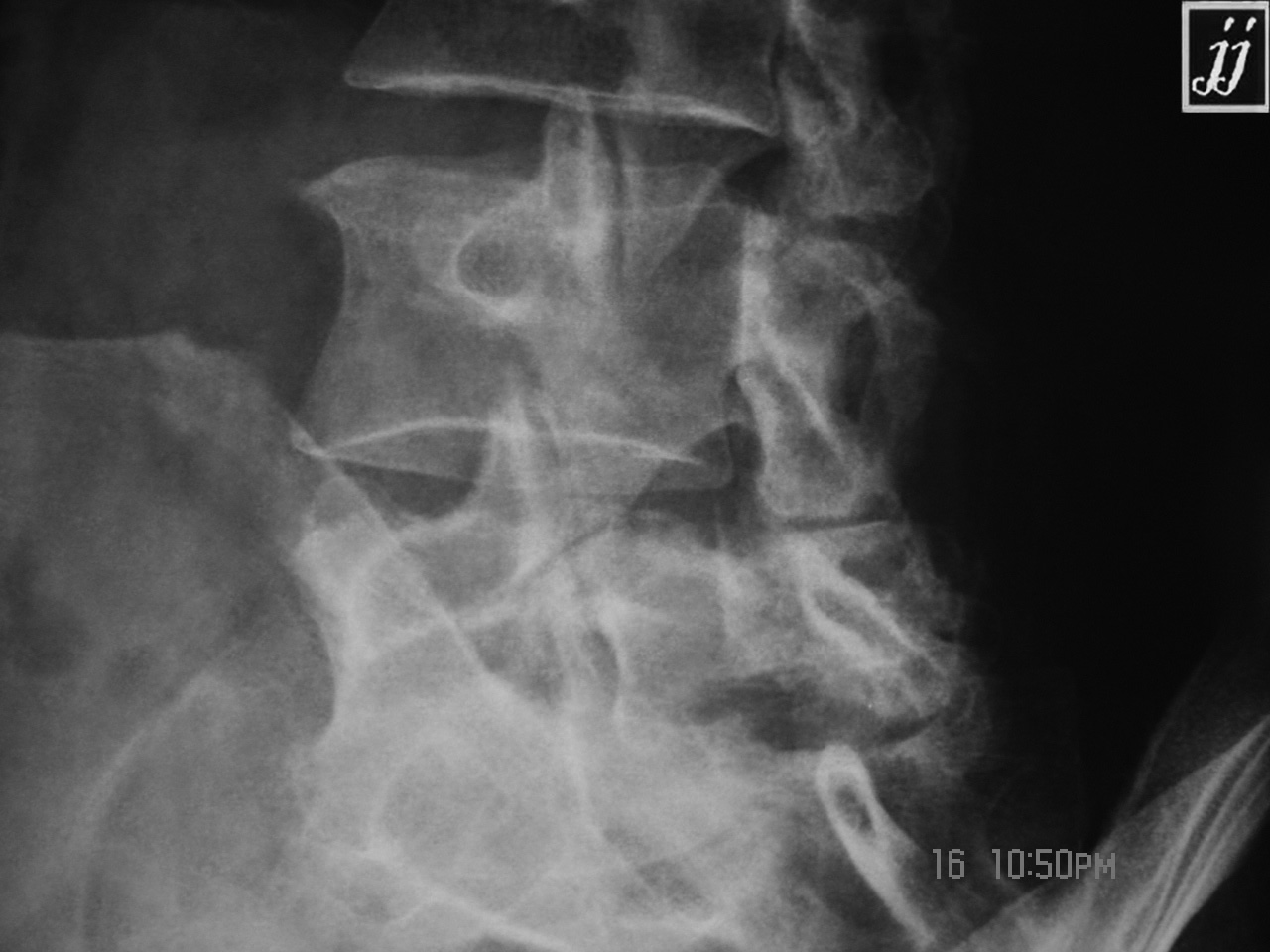 Spine Neck Fracture Of Scotty Dog At L5 Spondylolysis 4 